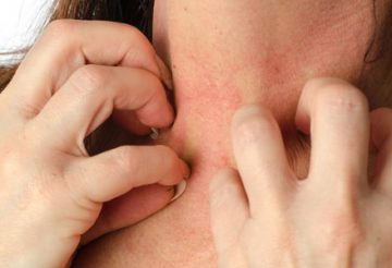 psoriasis