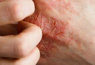 Soigner le psoriasis