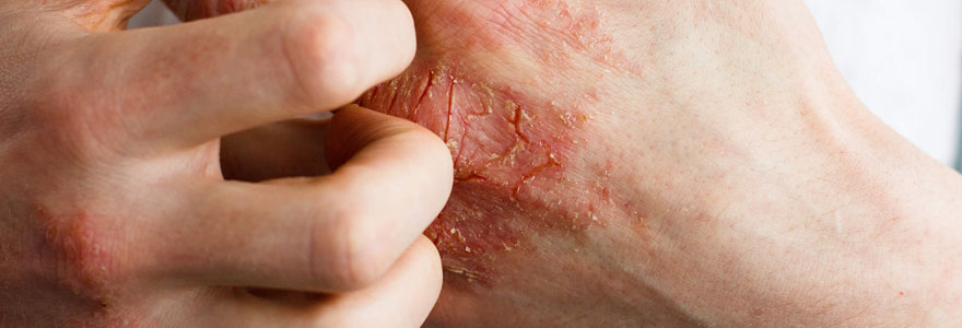 Soigner le psoriasis